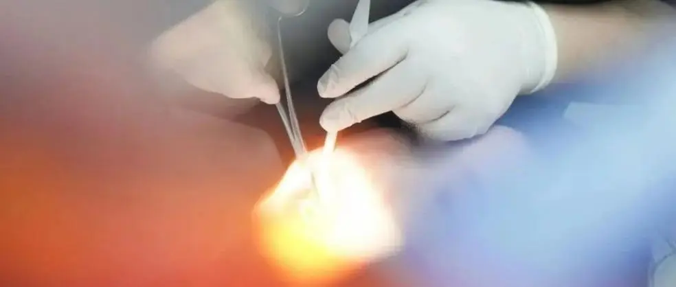 _心梗拔牙注意事项_心梗病人拔牙